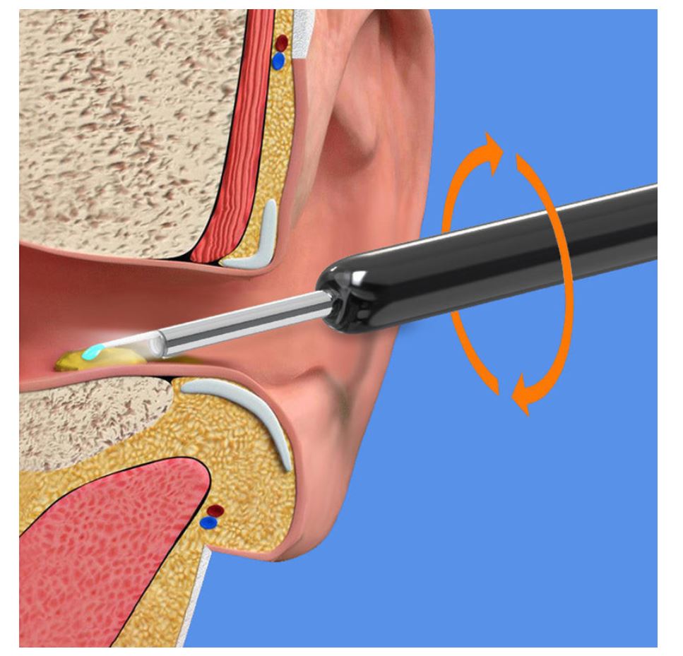Smart Visual Earwax Removal Kit – HD Camera Ear Cleaner with LED & WiFi Connection