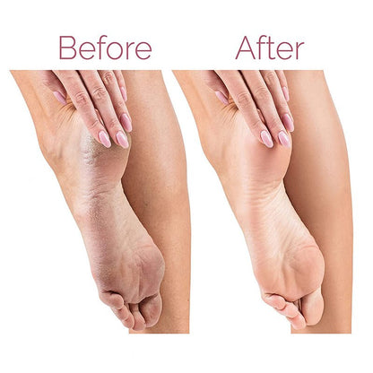 Electric Pedicure Foot File – Rechargeable Callus Remover for Smooth & Soft Feet