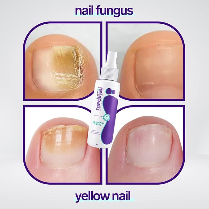 🦶 Jaysuing Nail Fungus Spray – Fast & Effective Nail Repair Treatment (100ml)