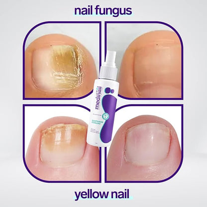 🦶 Jaysuing Nail Fungus Spray – Fast & Effective Nail Repair Treatment (100ml)