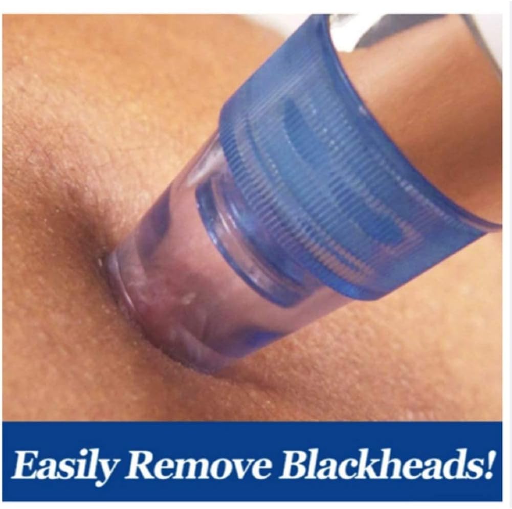 Blackhead Remover Pore Vacuum – USB Rechargeable Facial Deep Cleaning Device
